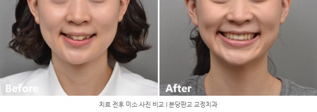 분당판교 교정치과 I 토끼이 교정치료 전후 미소 사진