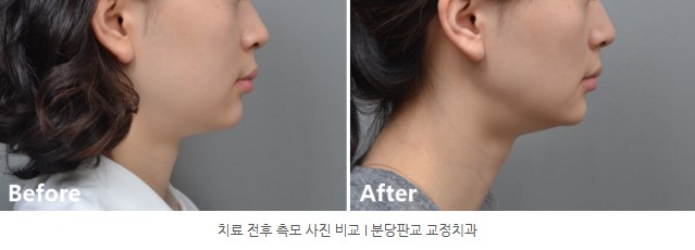 분당판교 교정치과 I 토끼이 교정치료 전후 측모사진