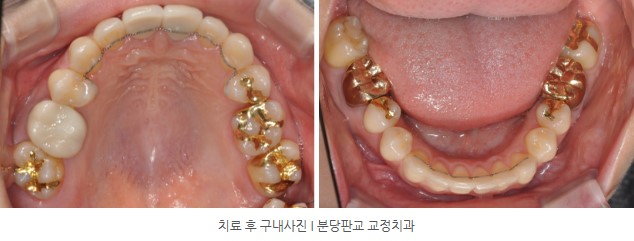 분당판교 교정치과 I 토끼이 교정치료 후 구내사진