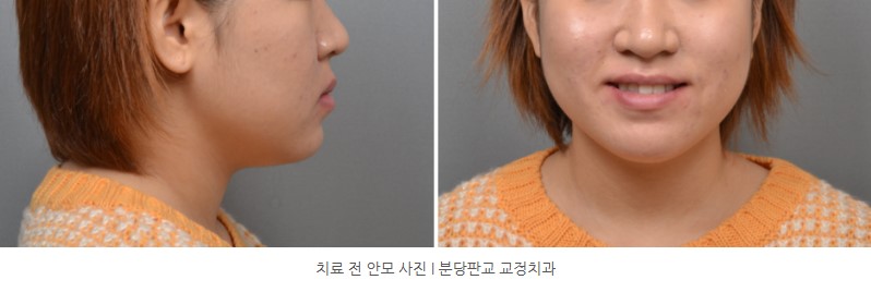 분당판교교정치과 I 돌출입, 매복치 치료 전 안모사진