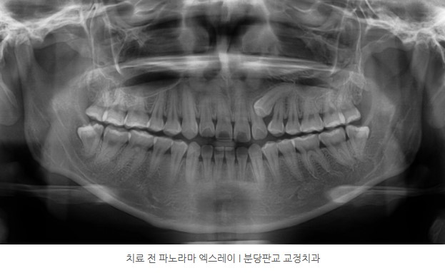 분당판교교정치과 I 돌출입, 매복치 치료 전 파노라마 엑스레이