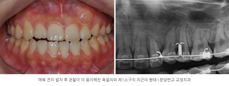 분당판교교정치과 I 매복치와 인접치의 치근 손상