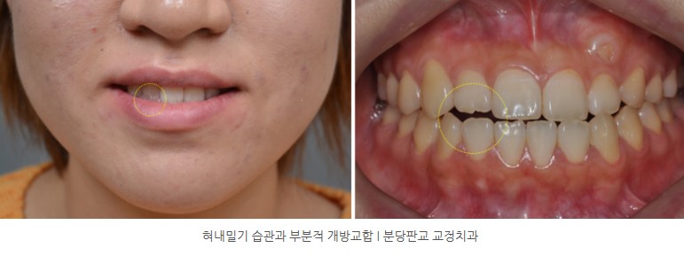분당판교교정치과 I 혀내밀기 습관과 부분적 개방교합