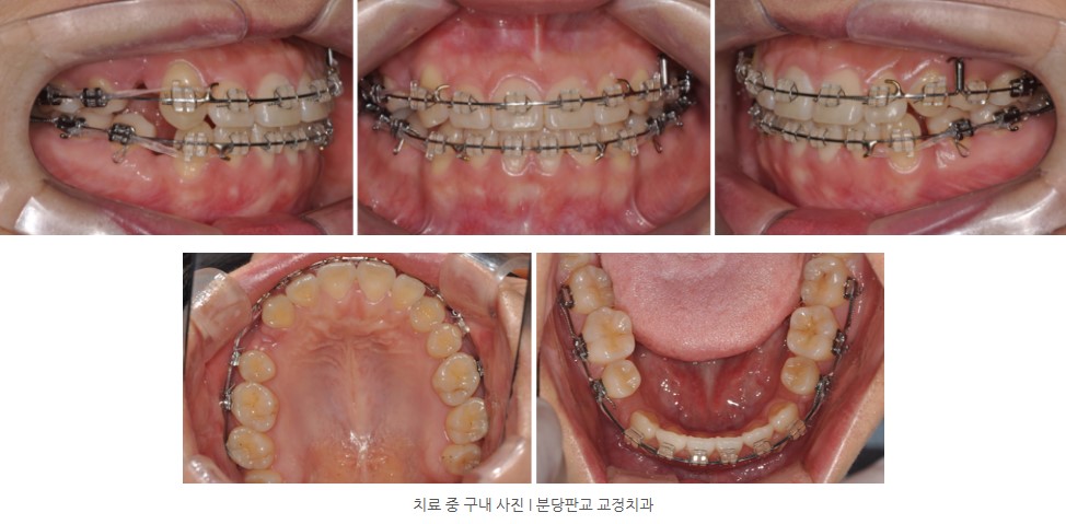 분당판교교정치과 I 돌출입, 매복치 치료 중 구내 사진