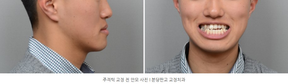 주걱턱 교정 전 안모사진 I 분당판교 교정치과 서울리인치과 서울리인교정치과
