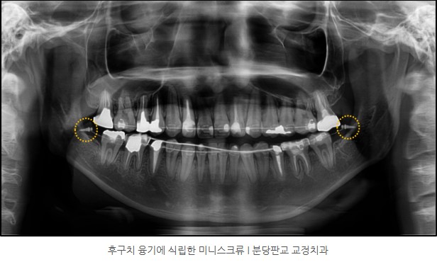 주걱턱 교정 미니스크류 식립 I 분당판교 교정치과 서울리인치과 서울리인교정치과