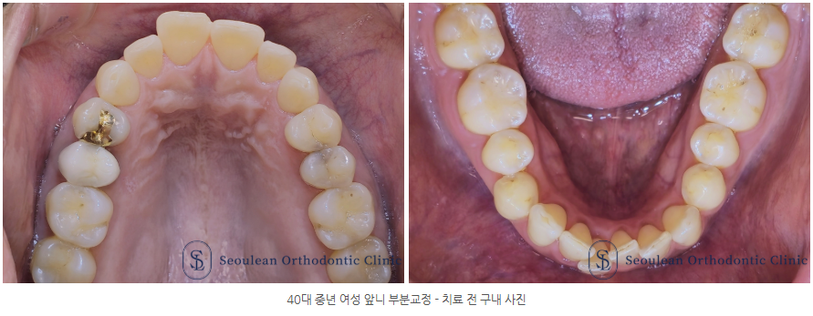 40대 중년 앞니 부분교정 - 치료 전 구내 사진 40대 중년 앞니 부분교정 - 치료 전 구내 사진