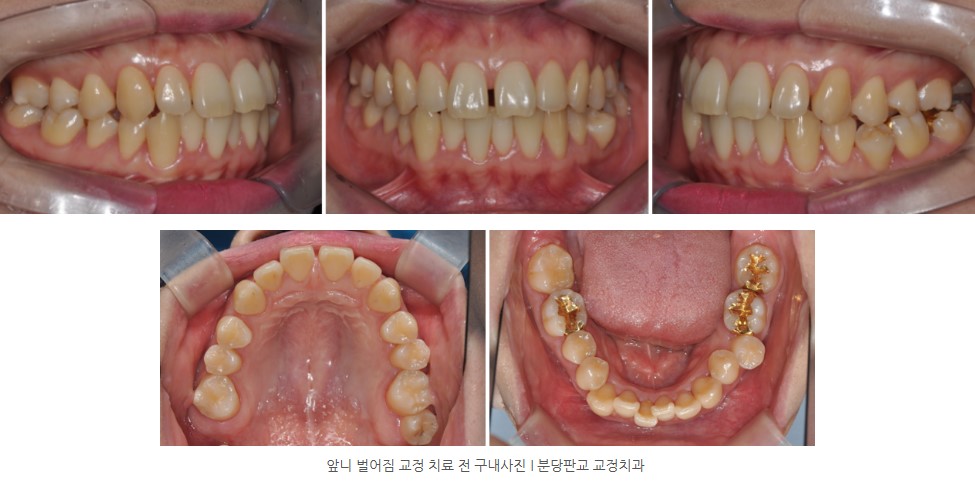 앞니 벌어짐 교정치료 전 구내사진 I 판교교정치과 분당교정치과