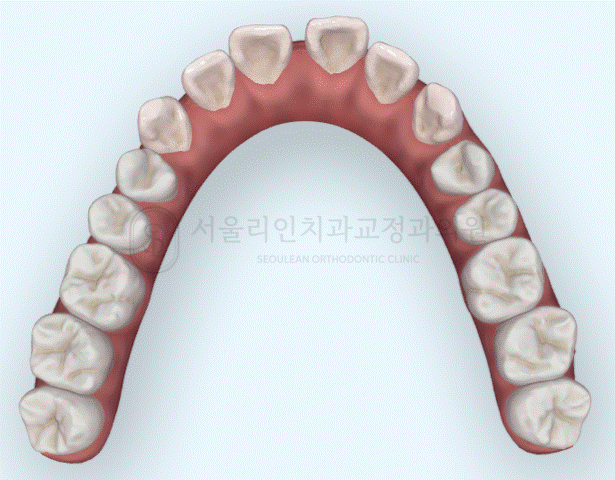 치아 사이 공간 폐쇄 I 판교교정치과 분당교정치과