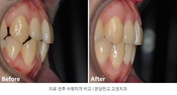 교정치료 전후 비교 I 판교교정치과 분당교정치과
