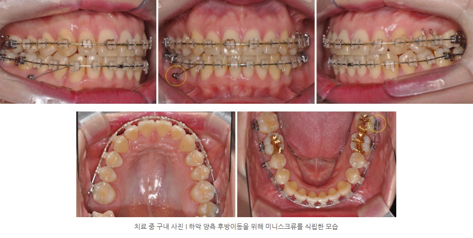 비발치교정 치료 I 판교교정치과 분당교정치과
