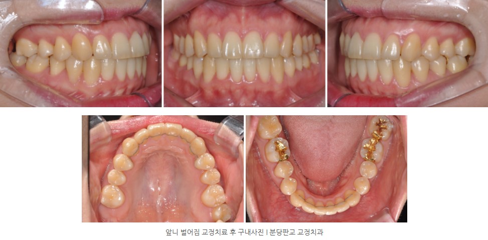 앞니벌어짐 교정치료 후 구내사진 I 판교교정치과 분당교정치과