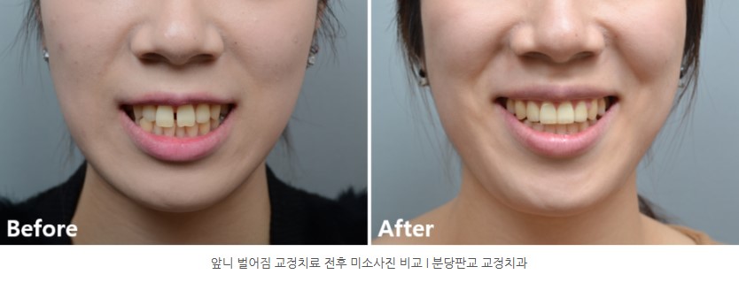 앞니 벌어짐 교정치료 후 미소사진 비교 I 판교교정치과 분당교정치과