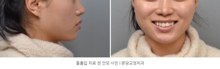 돌출입 교정 전 안모사진 I 분당교정치과