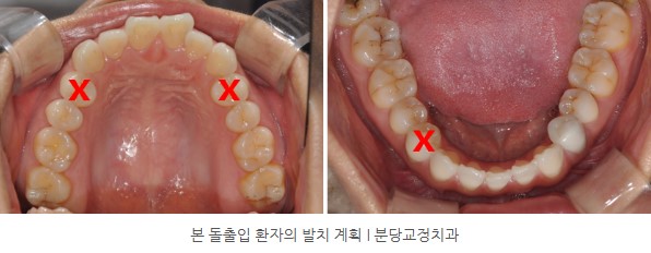 돌출입 환자의 발치 I 분당교정치과