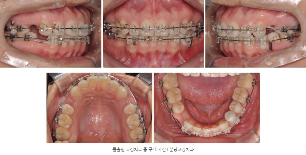 돌출입 교정치료 중 미니스크류 식립한 구내 사진 I 분당교정치과
