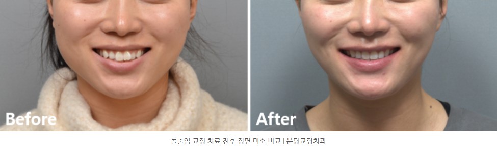 돌출입 교정치료 전후 미소 사진 I 분당교정치과