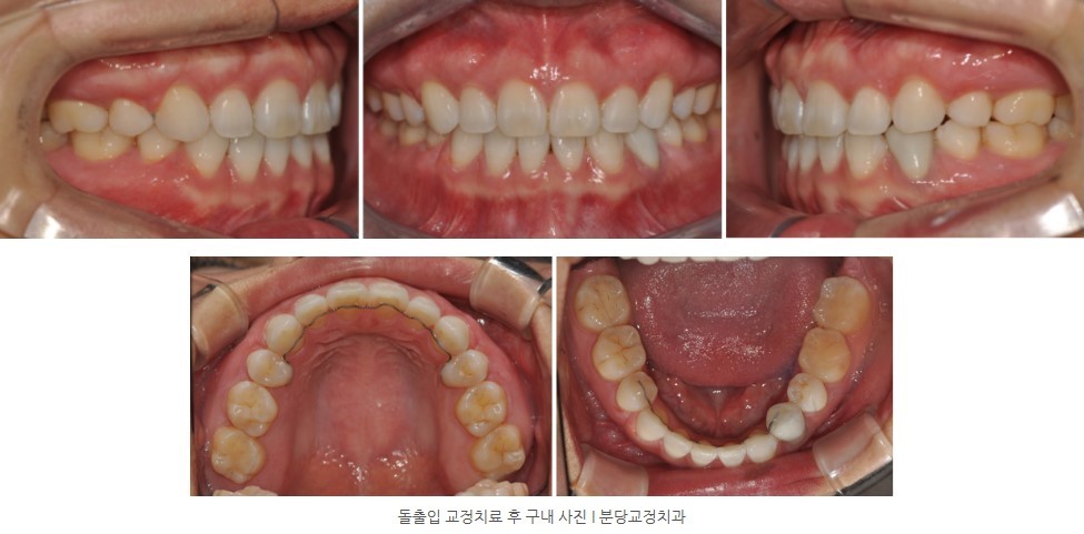 돌출입 교정치료 후 구내 사진 I 분당교정치과