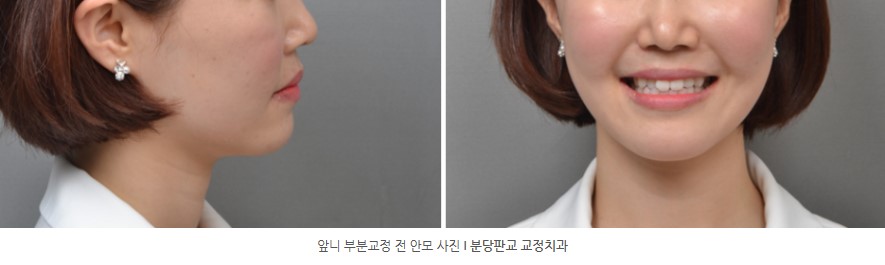 앞니부분교정 분당교정치과 판교교정치과 서울리인치과