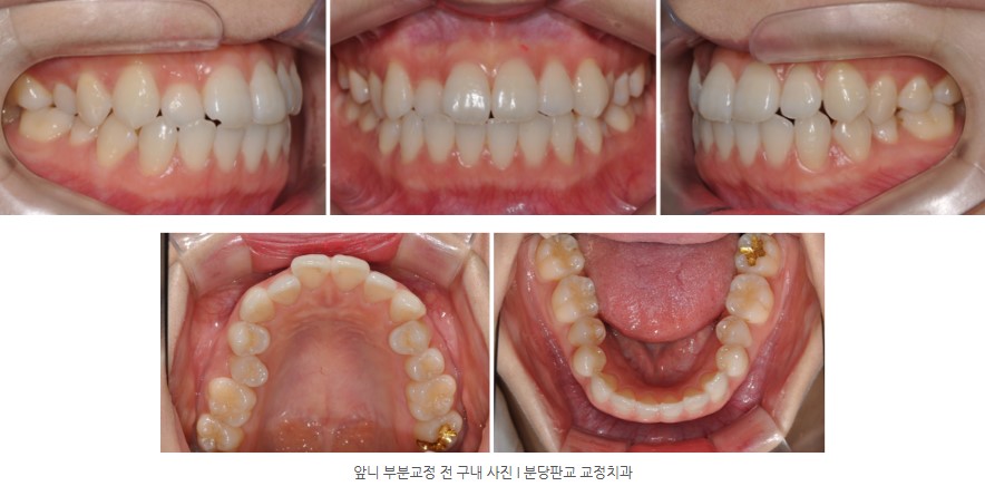 앞니부분교정 전 구내사진 I 분당교정치과 판교교정치과 서울리인치과