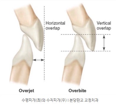 수평피개 수직피개 앞니부분교정 I 분당교정치과 판교교정치과 서울리인치과
