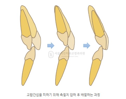 측절치 반대교합 교정치료 I 분당교정치과 판교교정치과 서울리인치과