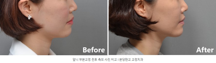 앞니교정 후 얼굴사진 I 분당교정치과 판교교정치과 서울리인치과