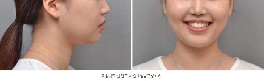 돌출입 치아교정 전 안모사진 분당교정치과 판교교정치과