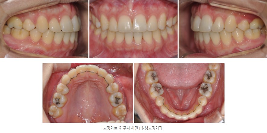 돌출입 치아교정 후 구내사진 분당교정치과 판교교정치과