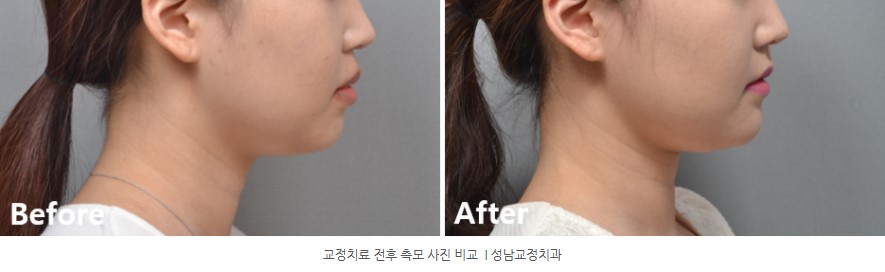 돌출입 치아교정 전후 측모사진 비교  분당교정치과 판교교정치과