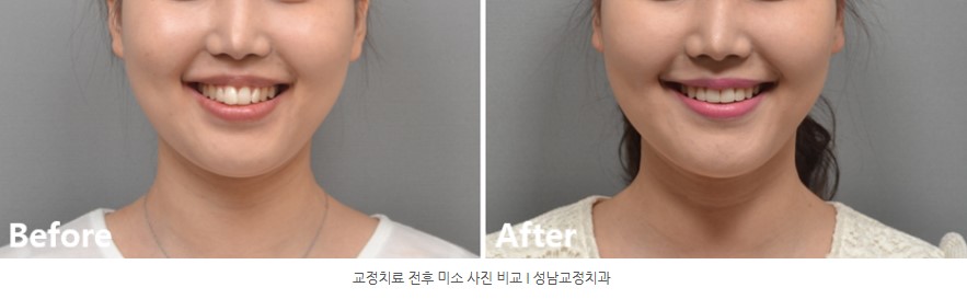 돌출입 치아교정 전후 미소사진 비교  분당교정치과 판교교정치과