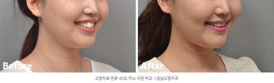 돌출입 치아교정 전후 45도 미소사진 비교  분당교정치과 판교교정치과