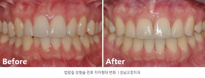 법랑질성형술 치아다듬기 서울리인치과 분당교정치과 판교교정치과