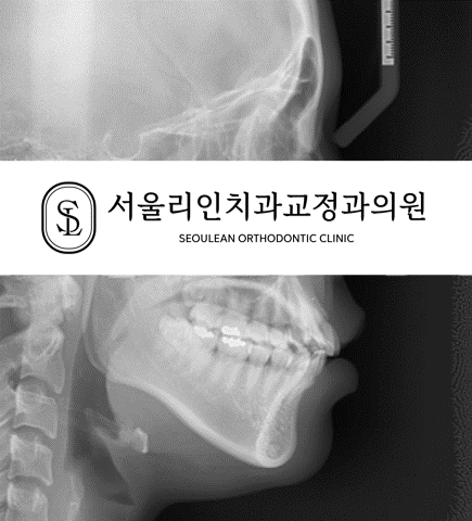 돌출입 교정치료 전후 측면 엑스레이 변화 분당교정치과 판교교정치과 성남교정치과