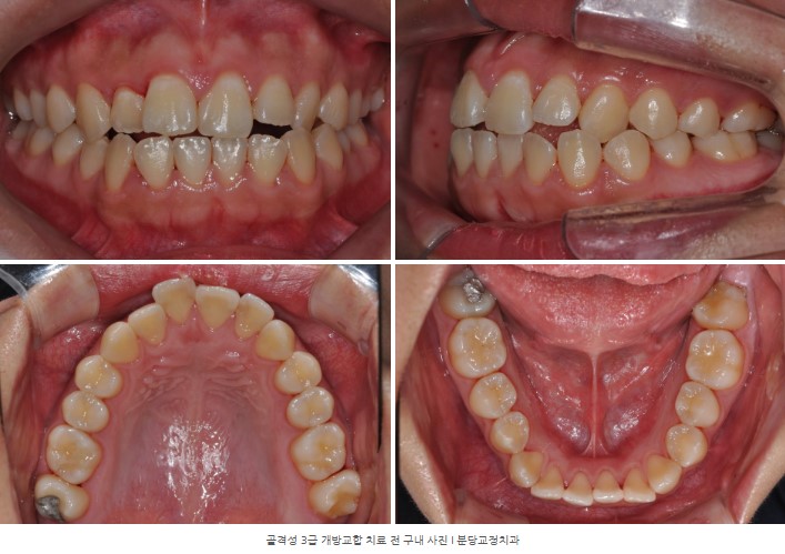 돌출을 동반한 골격성 3급 개방교합 치료 전 구내 사진 I 분당교정치과 서울리인치과