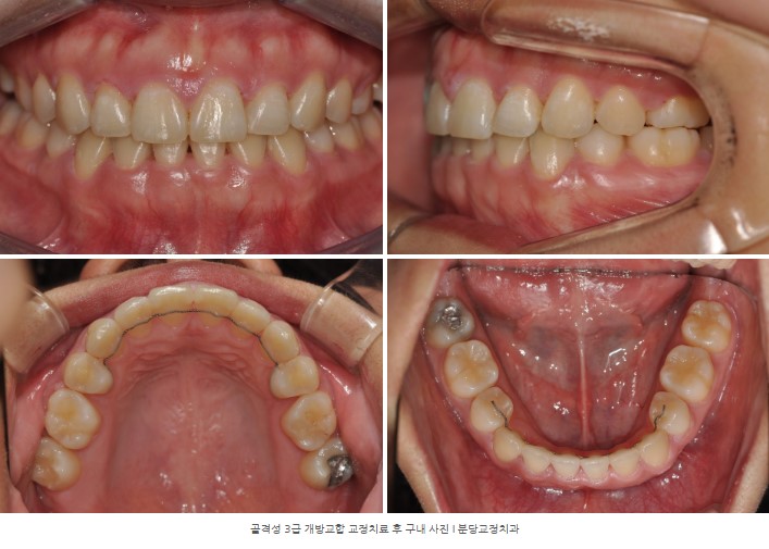 돌출을 동반한 골격성 3급 개방교합 치료 후 구내 사진 I 분당교정치과 서울리인치과