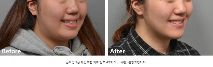 돌출을 동반한 골격성 3급 개방교합 치료 전후 45도 미소 사진 I 분당교정치과 서울리인치과