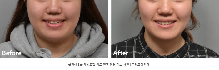 돌출을 동반한 골격성 3급 개방교합 치료 전후 미소 사진 I 분당교정치과 서울리인치과