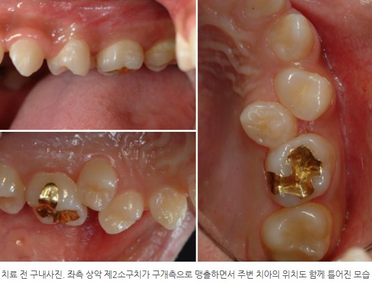 입천장맹출 영구치 치아교정, 서울리인치과교정과