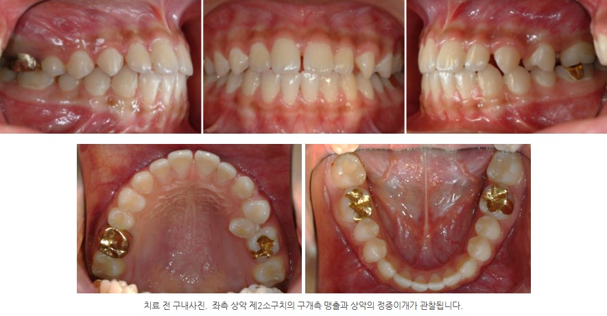 어린이 치아교정 전 구내사진,  서울리인치과교정과