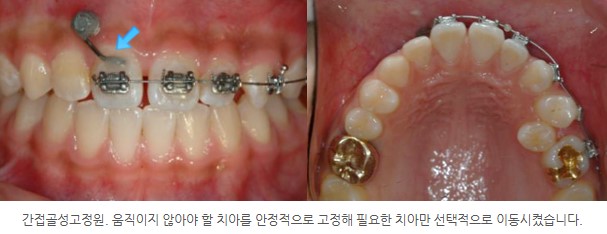 불편감을 최소화한 치아교정, 서울리인치과교정과