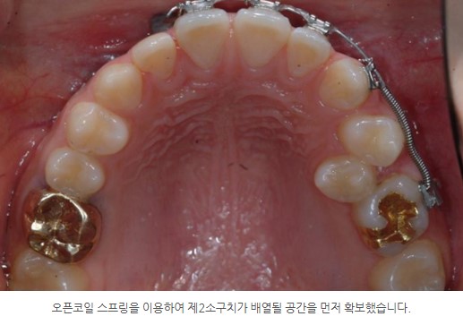 오픈코일 스프링 사용, 서울리인치과교정과