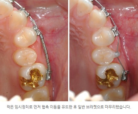 순차적 치아교정, 분당판교 교정치과 서울리인치과