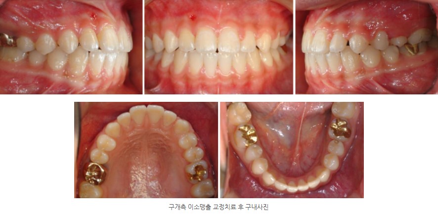 영구치 맹출 교정치료 후 구내사진, 분당판교 교정치과, 서울리인치과