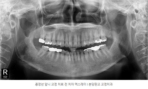 중장년 앞니 교정 전 치아 엑스레이 사진 I 분당판교교정치과