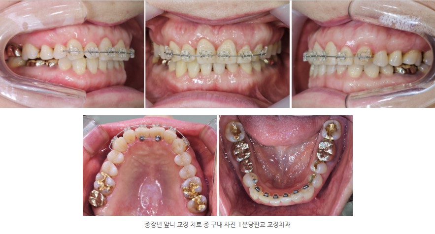 중장년 앞니 교정치료 중 구내 사진 I 분당판교교정치과