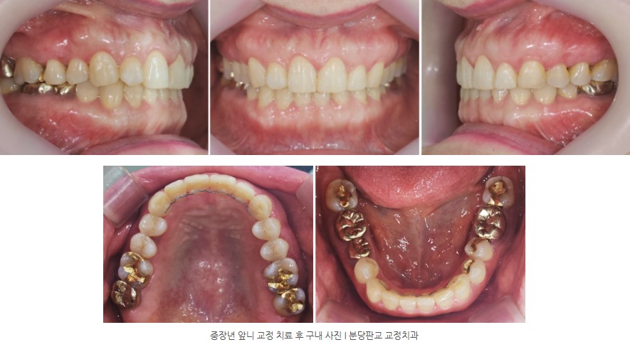 중장년 앞니 교정치료 후 구내 사진 I 분당판교교정치과