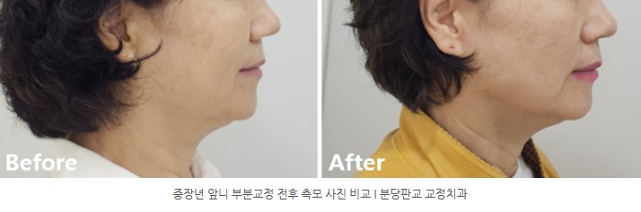 중장년 앞니 교정 전후 측모 사진 비교 I 분당판교교정치과