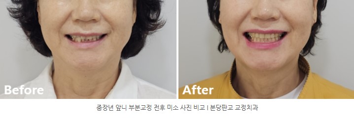 중장년 앞니 부분교정 전후 미소 사진 비교 I 분당판교교정치과