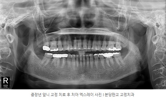 중장년 앞니 교정치료 후 치아 엑스레이사진 I 분당판교교정치과